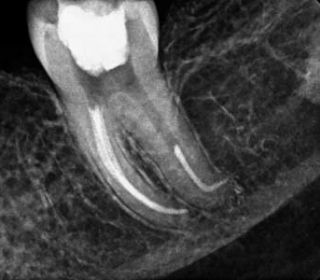endodontics