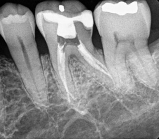 root canal endodontic partners