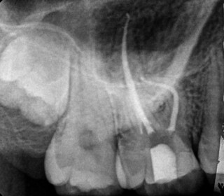 root canal endodontic partners