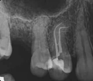 Root Canal 90 degree curve
